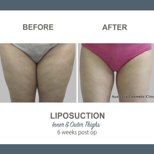 Thigh Liposuction Before and After Gallery