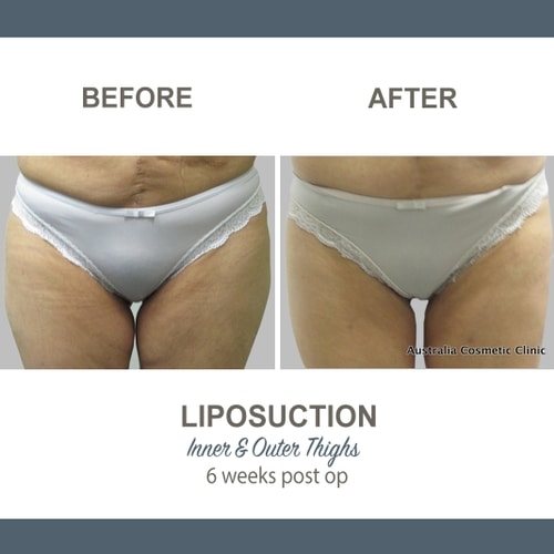 Thigh Liposuction Before and After Gallery