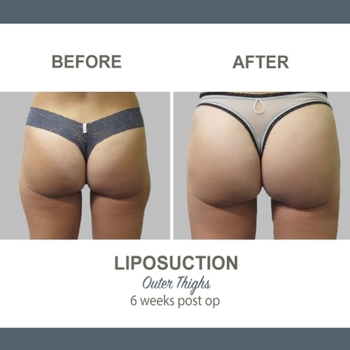 Thighs Liposuction Gallery Image