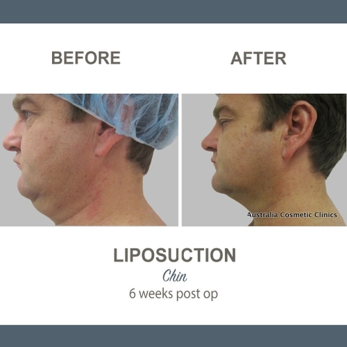 Bruising after Liposuction