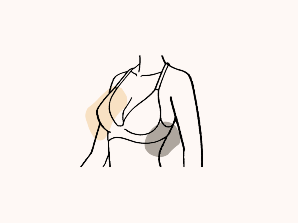 Managing Scars After Breast Reduction Surgery Featured Image
