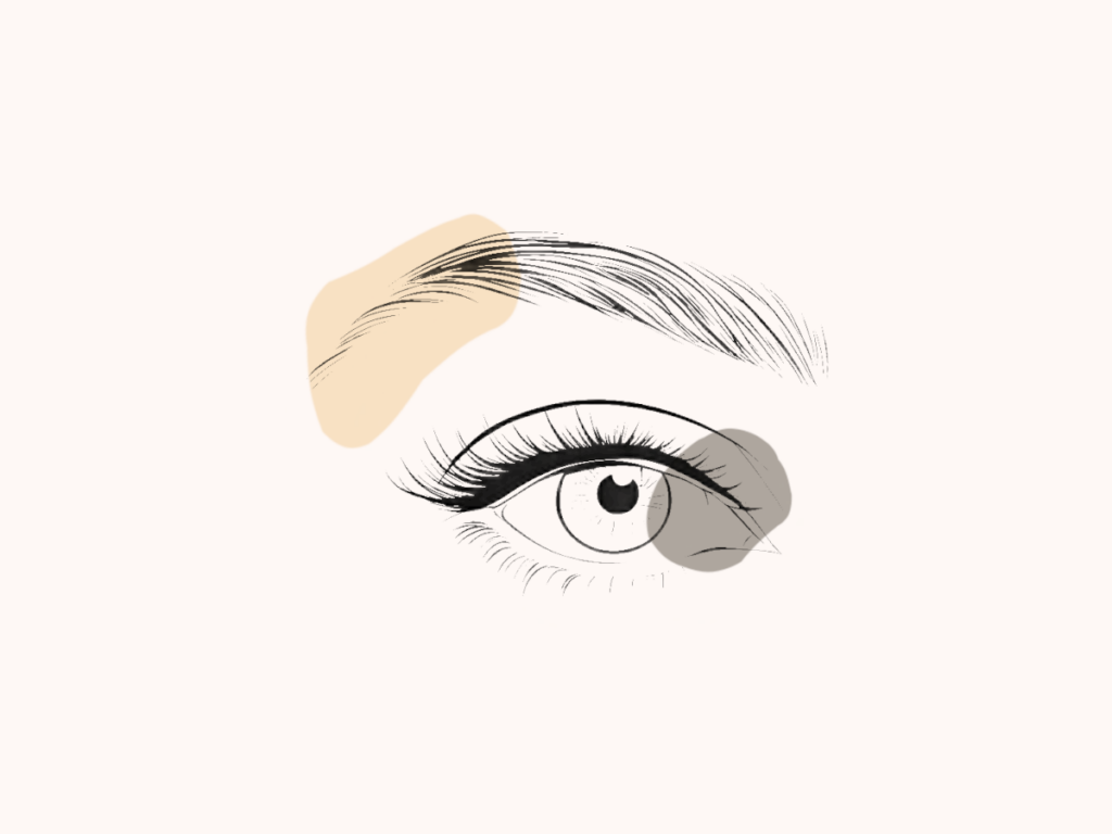 Recovery After Eyelid Surgery (Blepharoplasty)