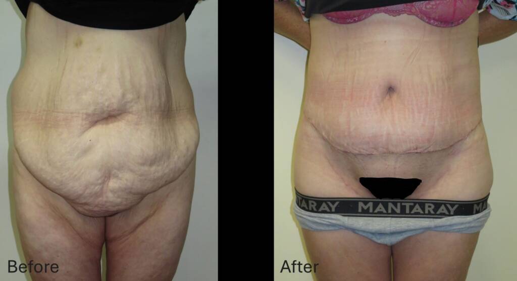 Abdominoplasty Patient 1- ACC image