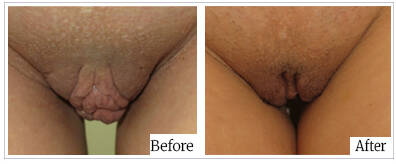 Labioplasty by Dr Mark Kohout - Australia Cosmetic Clinics 01