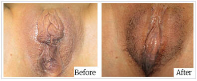 Labioplasty by Dr Mark Kohout - Australia Cosmetic Clinics 02