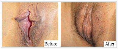 Labioplasty by Dr Mark Kohout - Australia Cosmetic Clinics 03