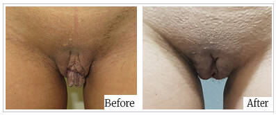 Labioplasty by Dr Mark Kohout - Australia Cosmetic Clinics 04