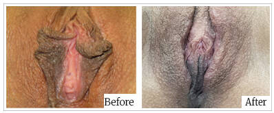 Labioplasty by Dr Mark Kohout - Australia Cosmetic Clinics 05
