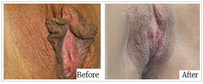 Labioplasty by Dr Mark Kohout - Australia Cosmetic Clinics 06