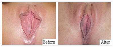 Labioplasty by Dr Mark Kohout - Australia Cosmetic Clinics 07