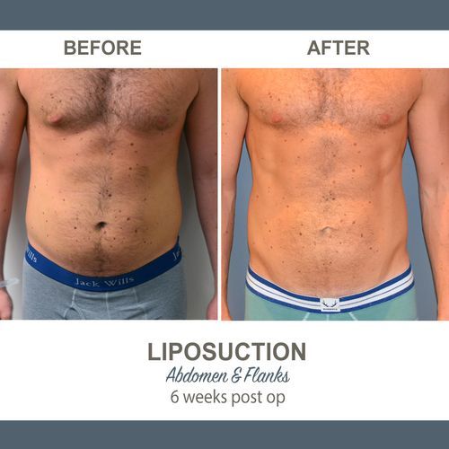 Liposuction patient 1 - ACC image