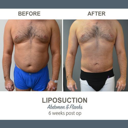 Liposuction patient 2- ACC image