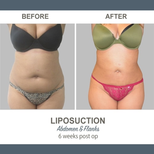Liposuction patient 3- ACC Image