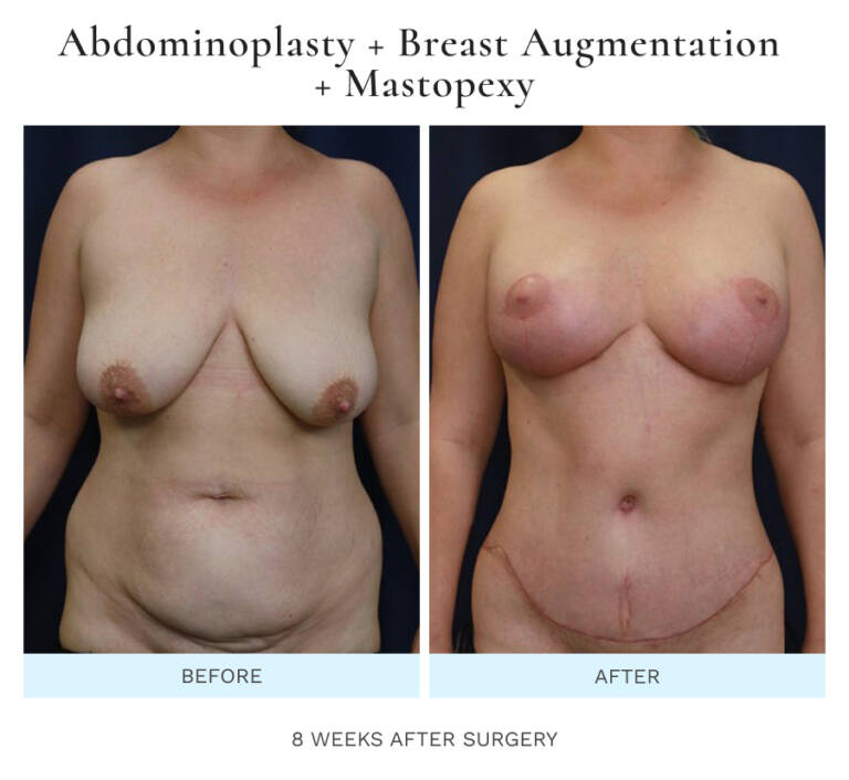 Tummy Tuck Photos (Abdominoplasty)