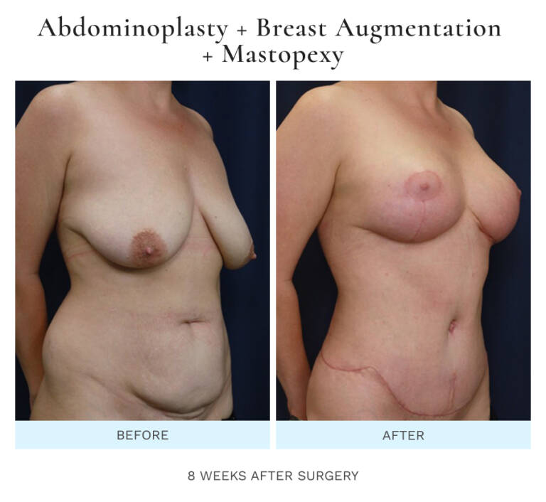 Breast Augmentation & Lift Photos