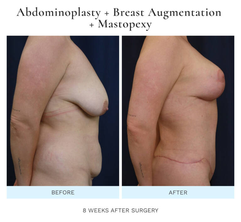 Tummy Tuck Photos (Abdominoplasty)