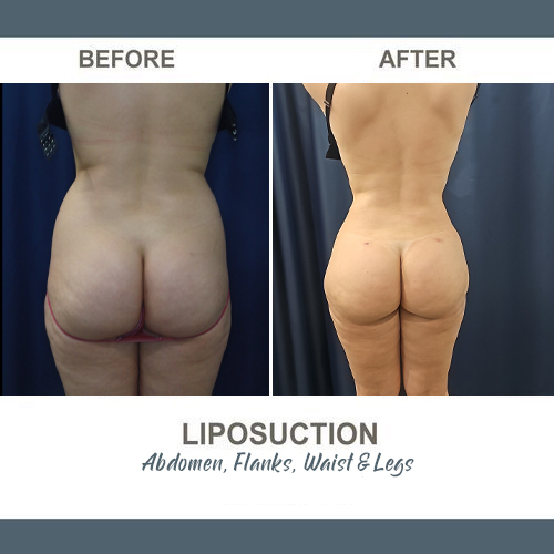 Flank Liposuction Photos