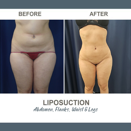 Flank Liposuction Photos