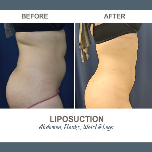Flank Liposuction Photos