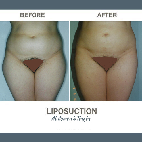 Thigh Liposuction Photos