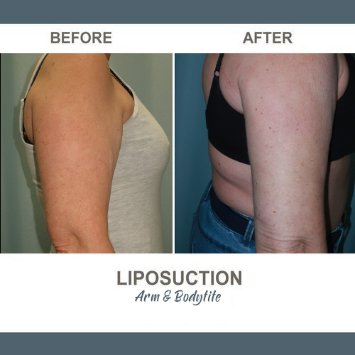 Arm Liposuction Photos