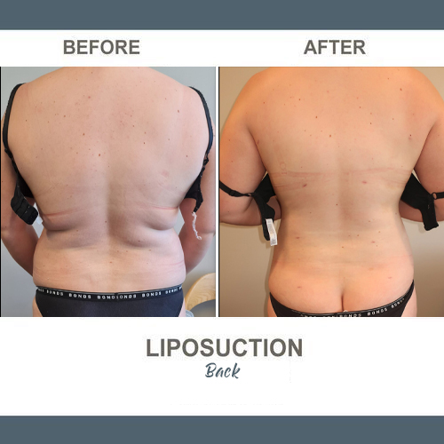 Back Liposuction Photos