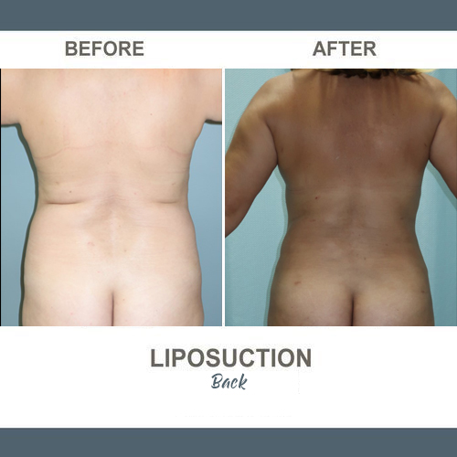 Back Liposuction Photos
