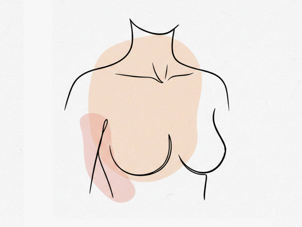 Breast Liposuction (Female) by ACC