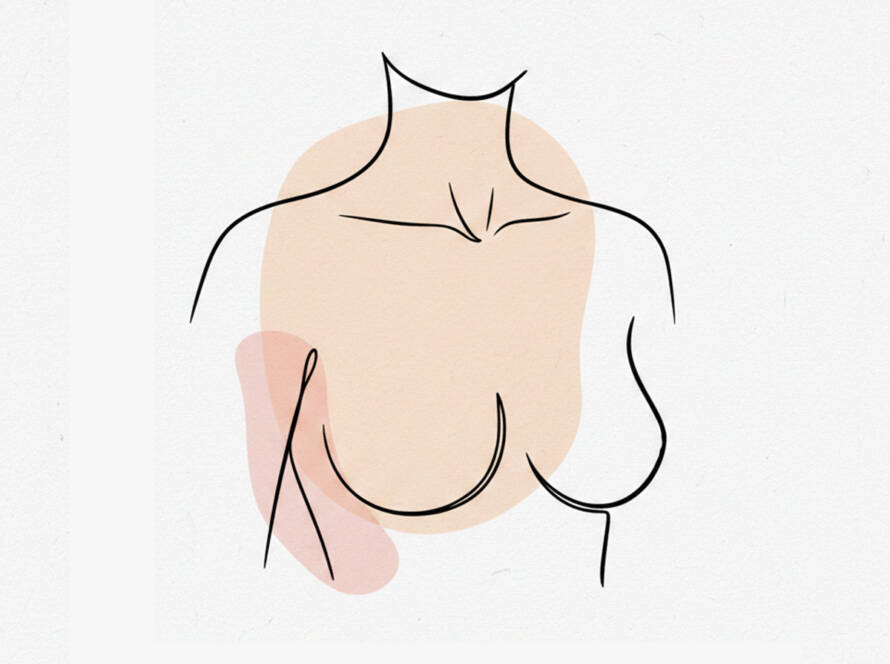 Breast Liposuction (Female) by ACC