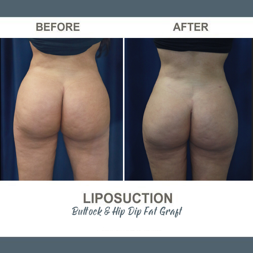 Thigh Liposuction Photos
