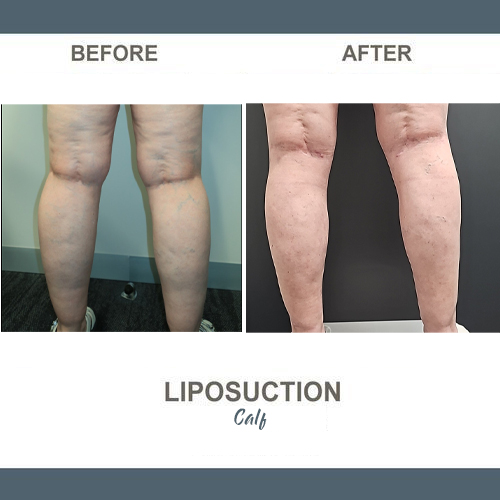 Calf Liposuction Photos