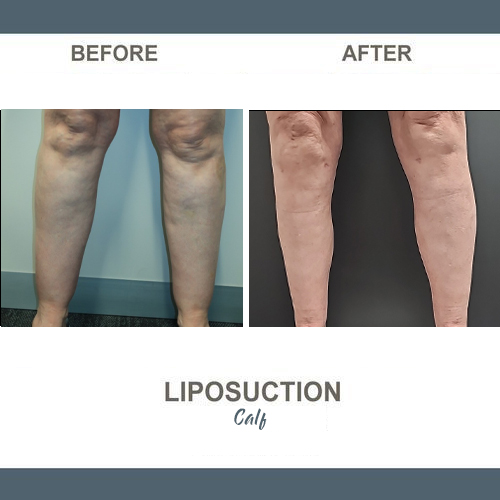 Calf Liposuction Photos