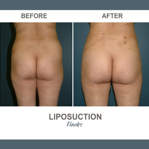 Flank Liposuction Photos
