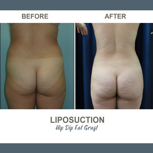 Thigh Liposuction Photos
