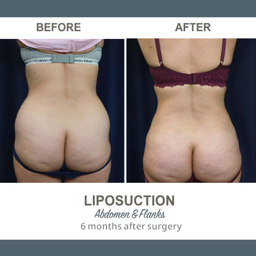 Flank Liposuction Photos
