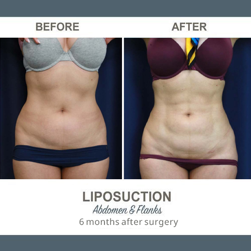 Flank Liposuction Photos