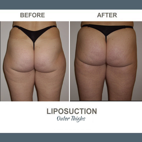 Thigh Liposuction Photos
