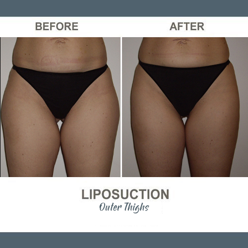 Thigh Liposuction Photos