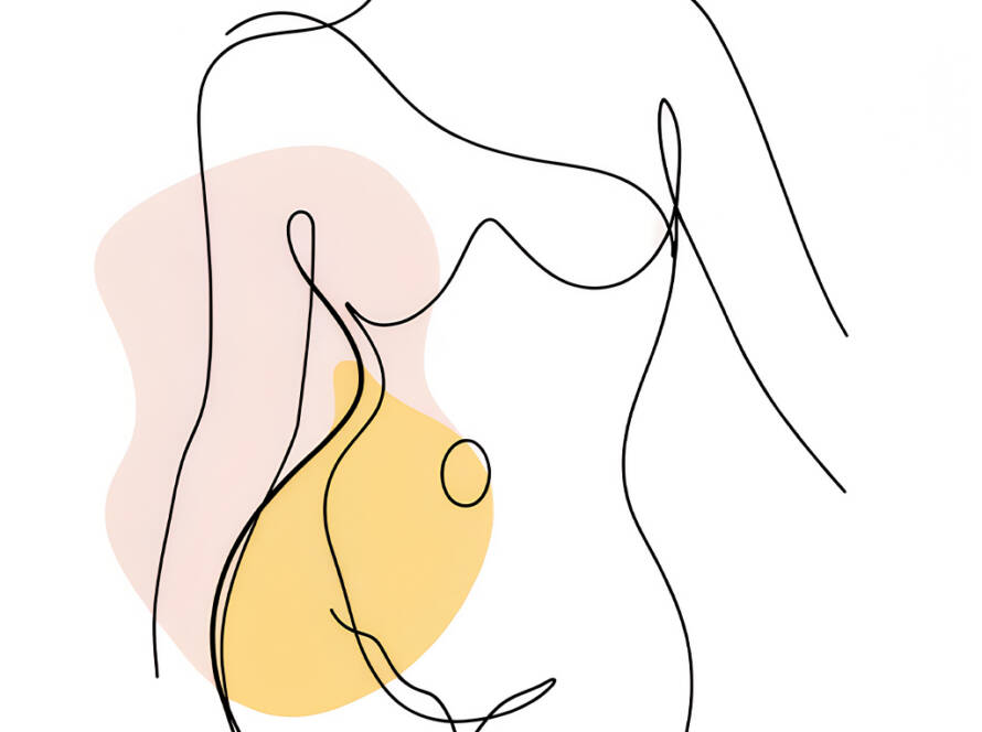 Can Patients With Split Muscles Have Liposuction by ACC