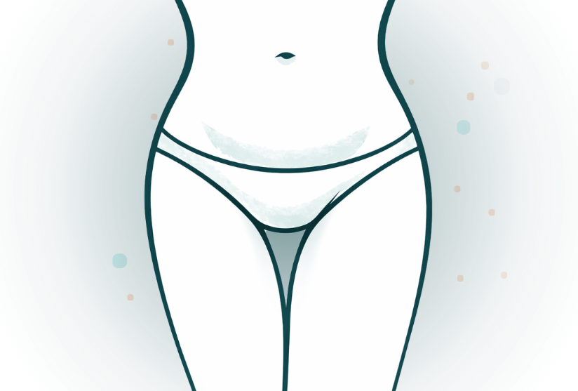 FUPA Liposuction Mons Pubis