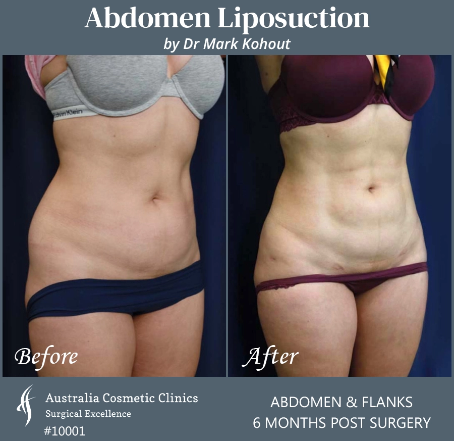 Abdomen Liposuction Patient 10001 45
