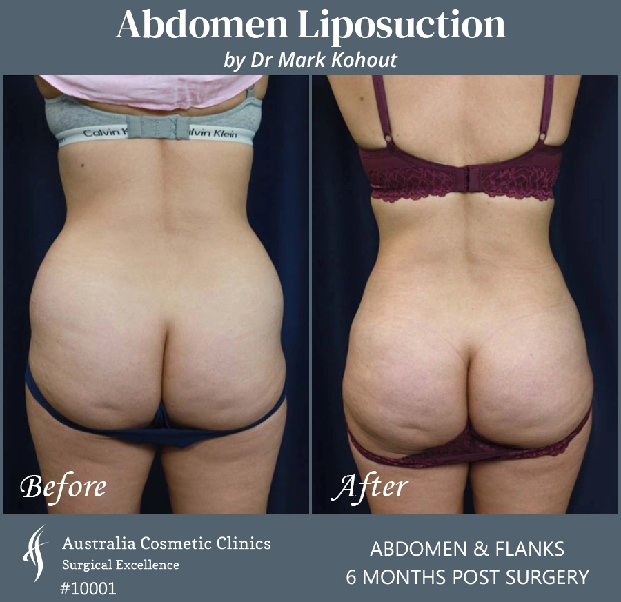 Abdomen Liposuction Patient 10001 BACK