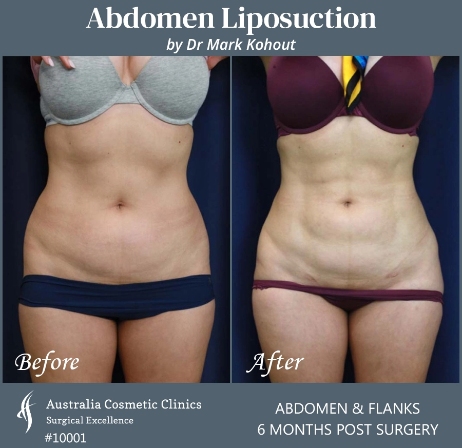 Abdomen Liposuction Patient 10001 FRONT
