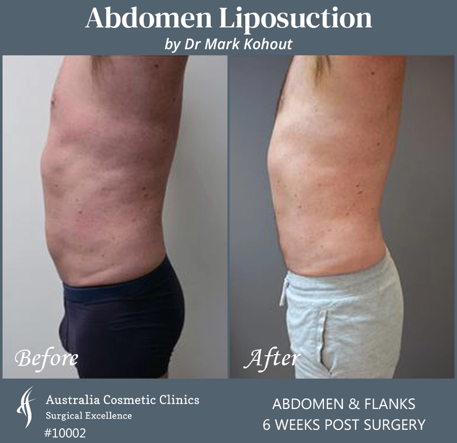 Abdomen Liposuction Patient 10002 SIDE