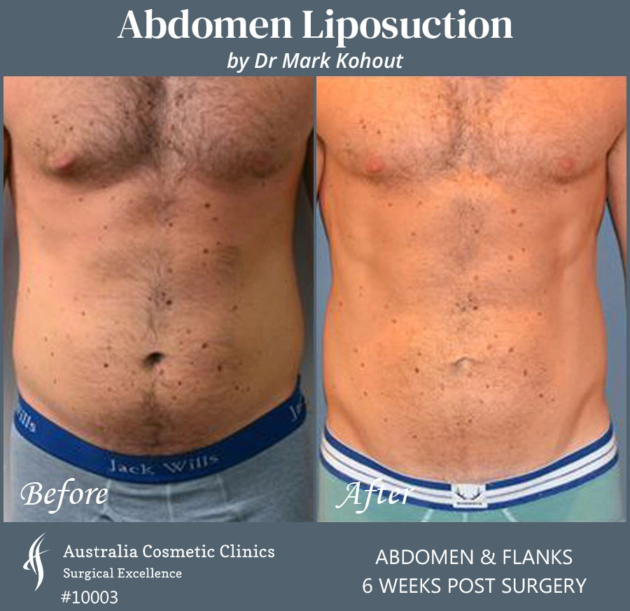 Abdomen Liposuction Patient 10003 FRONT