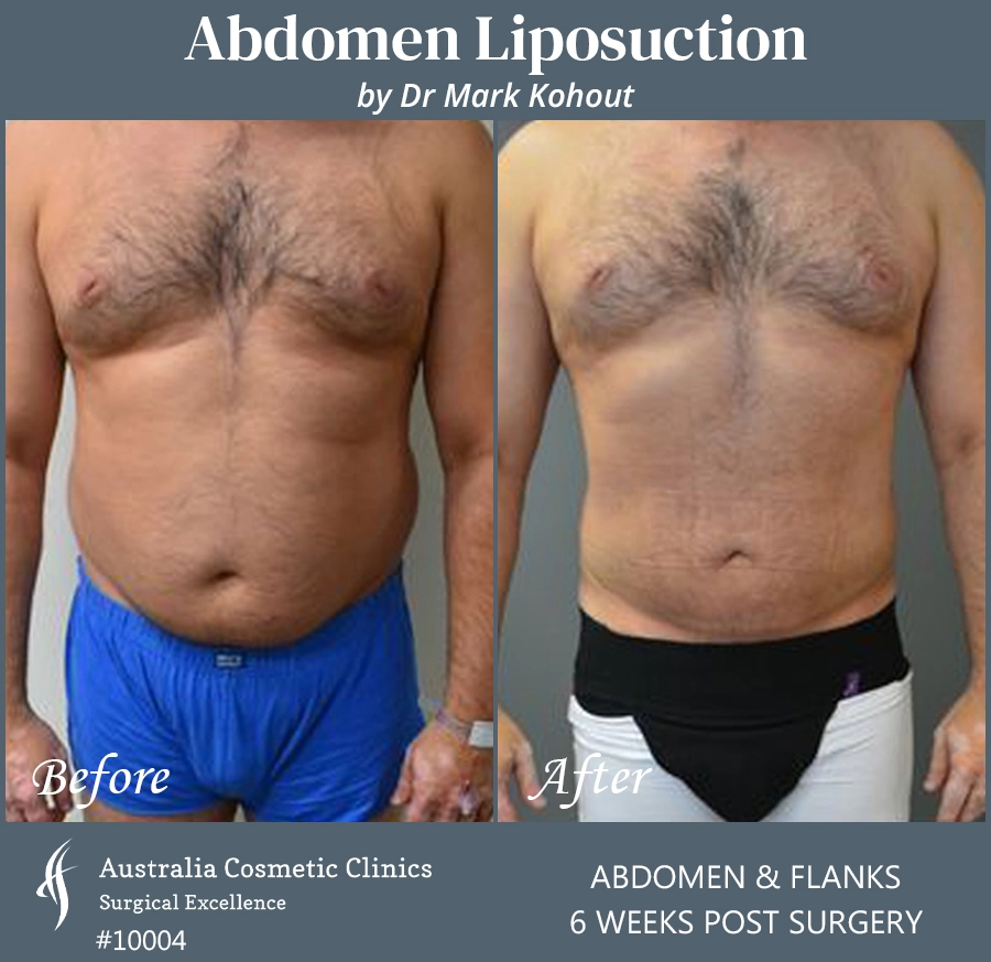 Abdomen Liposuction Patient 10004 FRONT