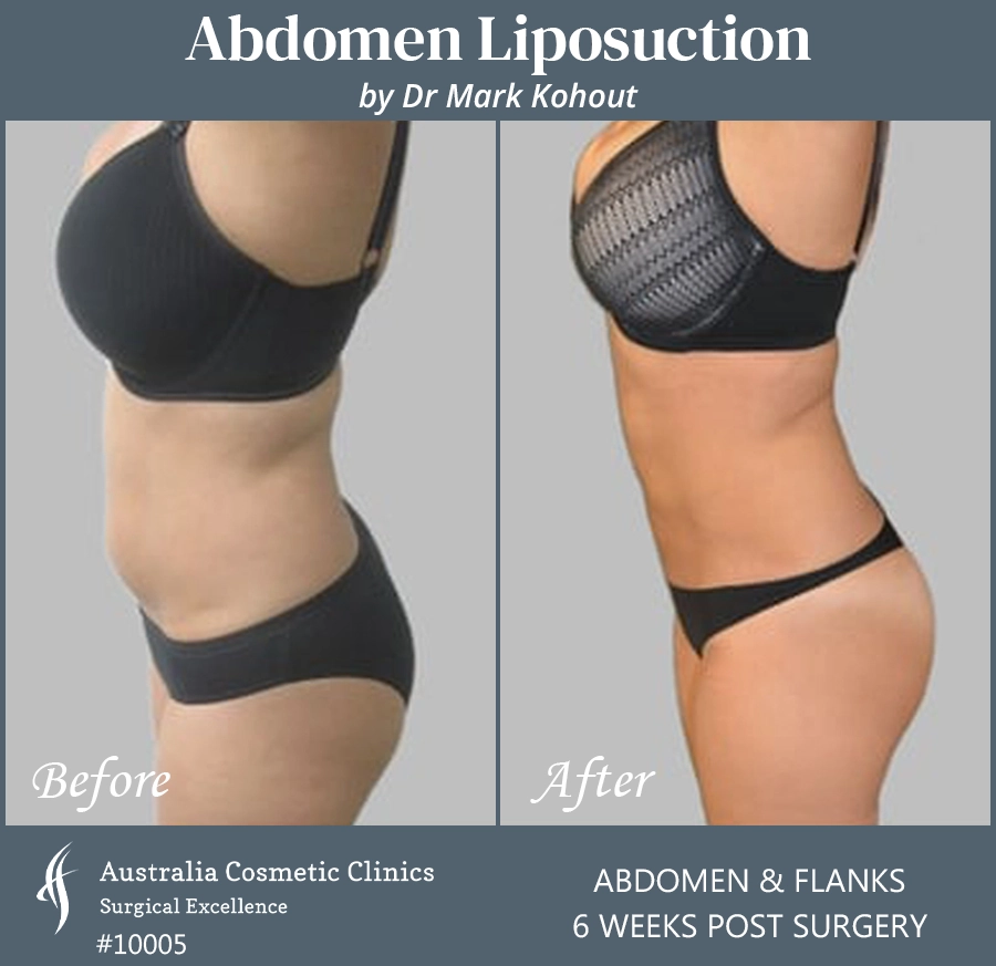 Abdomen Liposuction Patient 10005 SIDE