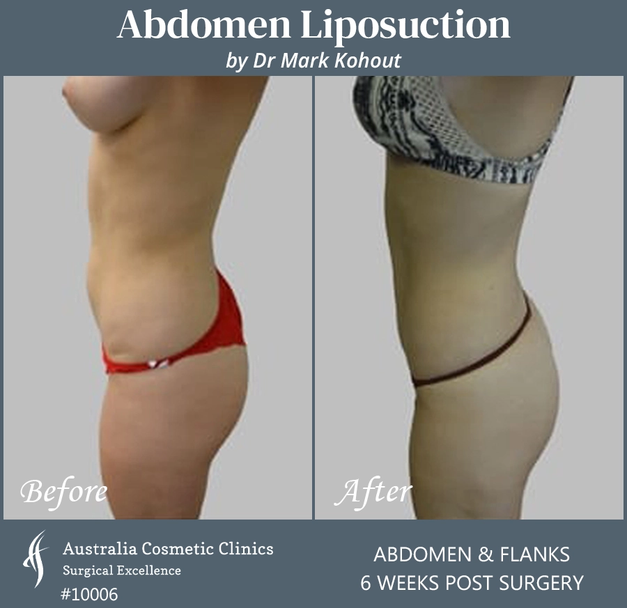 Abdomen Liposuction Patient 10006 SIDE