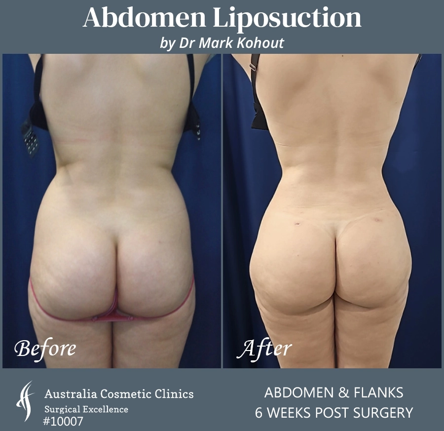 Abdomen Liposuction Patient 10007 BACK