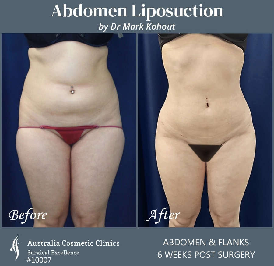 Abdomen Liposuction Patient 10007 FRONT